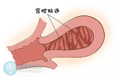 宫腔粘连能做试管婴儿吗，宫腔粘连做试管婴儿怀孕的几率高吗？