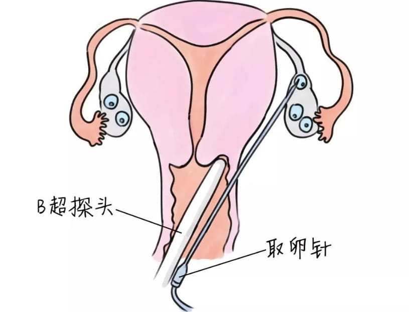 让我们详细了解一下取卵术！