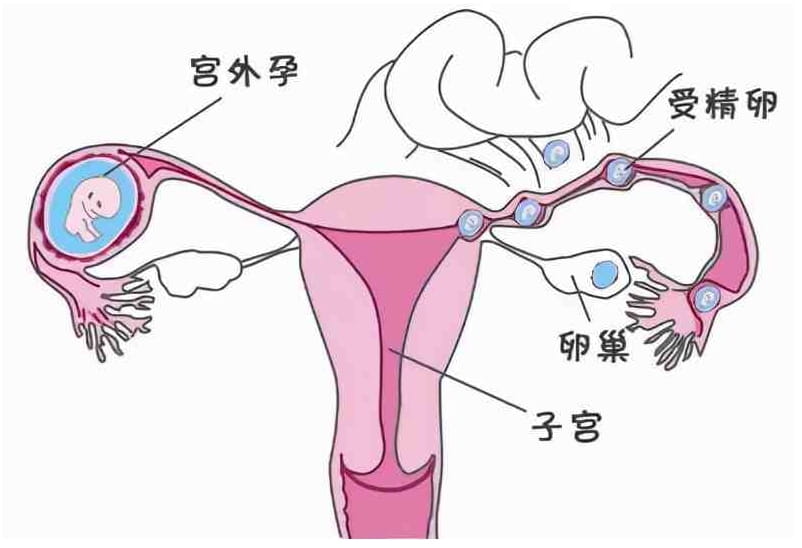 为什么输卵管积水会导致不孕？该如何治疗？