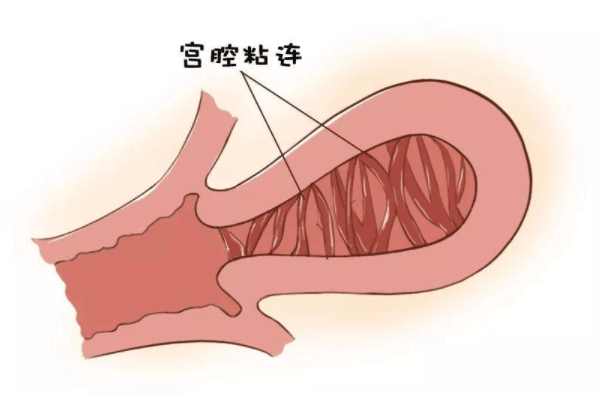 宫腔粘连导致不孕的原因有哪些？试管前该如何处理？